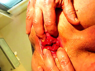 Wifes And And Husbands Anal Prolaps